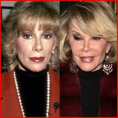 Joan-Rivers-Plastic-Surgery.jpg